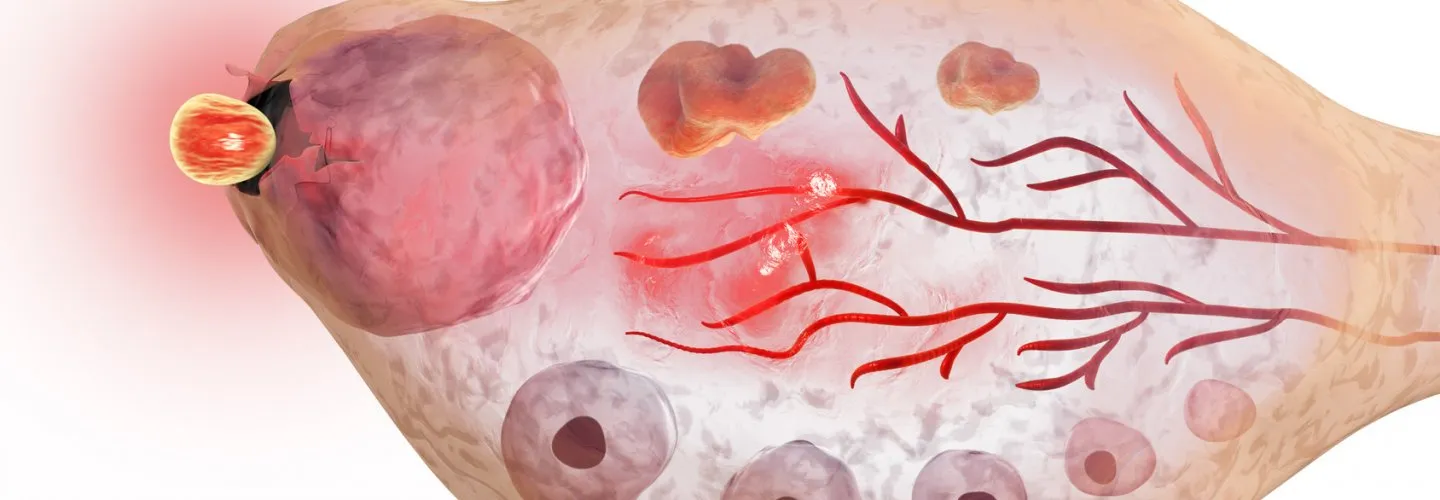 Tuboovarian Abse (TOA)