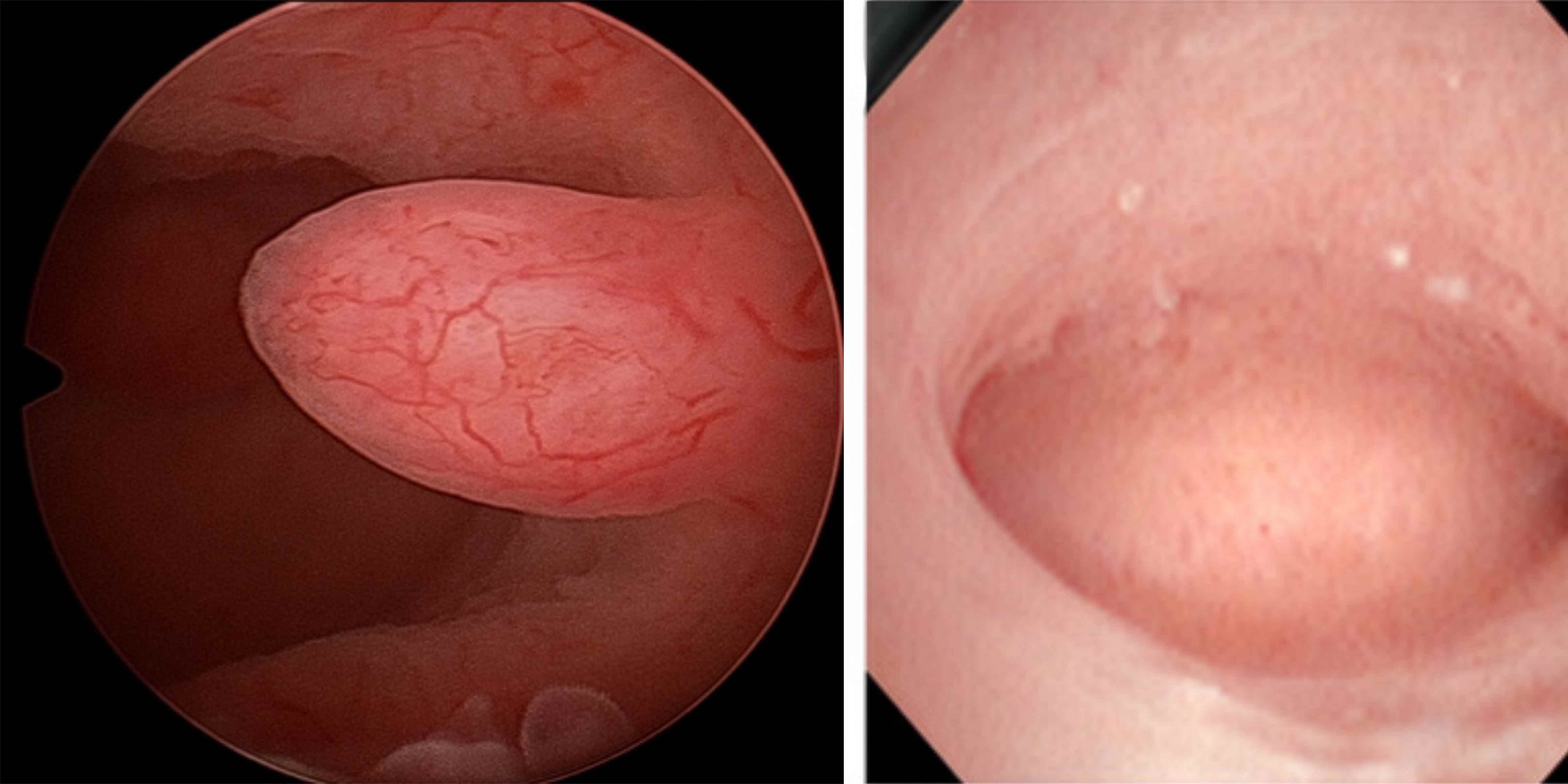 Hysteroscopic comparison between a normal uterine cavity and an endometrial polyp visible before IVF