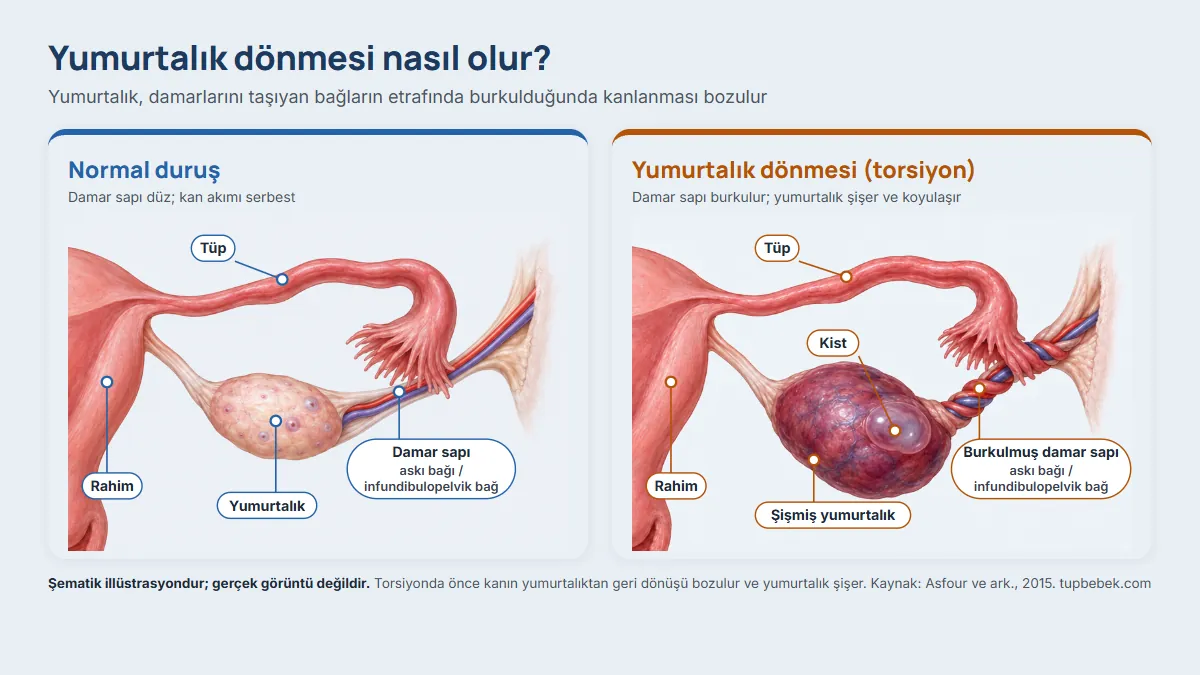 Şematik illüstrasyon: rahim, tüp ve yumurtalığın önden görünümü. Solda yumurtalığın damar sapı düz ve yumurtalık normal görünümde; sağda damar sapı ip gibi burkulmuş, yumurtalık şişmiş ve koyulaşmış, üzerinde bir kist var.