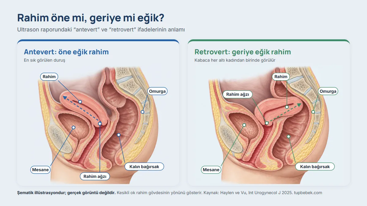 Şematik illüstrasyon: kadın leğen bölgesinin yandan kesiti. Solda rahim gövdesi öne, mesanenin üzerine doğru eğik (antevert); sağda rahim gövdesi geriye, kalın bağırsak ve omurgaya doğru eğik (retrovert). Her iki çizimde mesane, rahim ağzı, kalın bağırsak ve omurga işaretli.